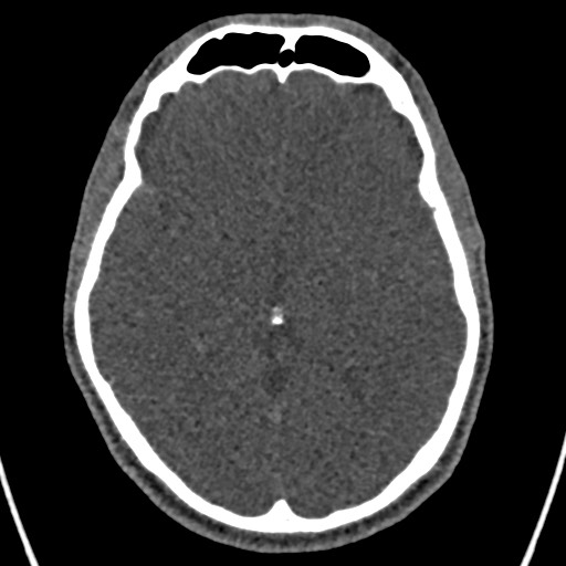 Cerebral arteriovenous malformation (Radiopaedia 78188-90746 Axial non-contrast 84).jpg
