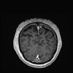 Cerebral arteriovenous malformation (Radiopaedia 84015-99245 Coronal T1 C+ 148).jpg