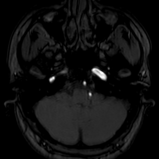 Cerebral arteriovenous malformation at posterior body of corpus callosum (Radiopaedia 74111-84925 Axial MRA 31).jpg