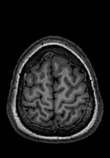 Cerebral arteriovenous malformation at posterior body of corpus callosum (Radiopaedia 74111-84925 Axial T1 26).jpg