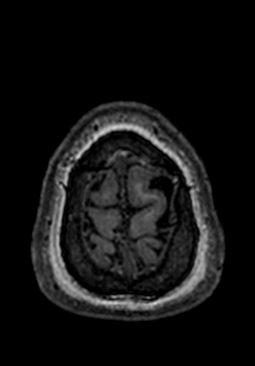 Cerebral arteriovenous malformation at posterior body of corpus callosum (Radiopaedia 74111-84925 Axial T1 4).jpg