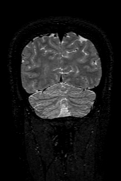 Cerebral arteriovenous malformation at posterior body of corpus callosum (Radiopaedia 74111-84925 Coronal T2 152).jpg