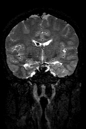 Cerebral arteriovenous malformation at posterior body of corpus callosum (Radiopaedia 74111-84925 Coronal T2 84).jpg