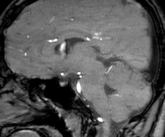 File:Cerebral arteriovenous malformation at posterior body of corpus callosum (Radiopaedia 74111-84925 J 182).jpg