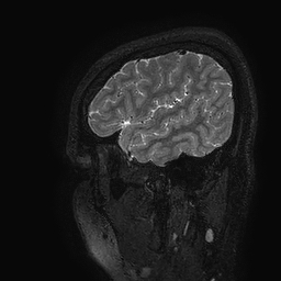Cerebral arteriovenous malformation at posterior body of corpus callosum (Radiopaedia 74111-84925 Sagittal T2 119).jpg