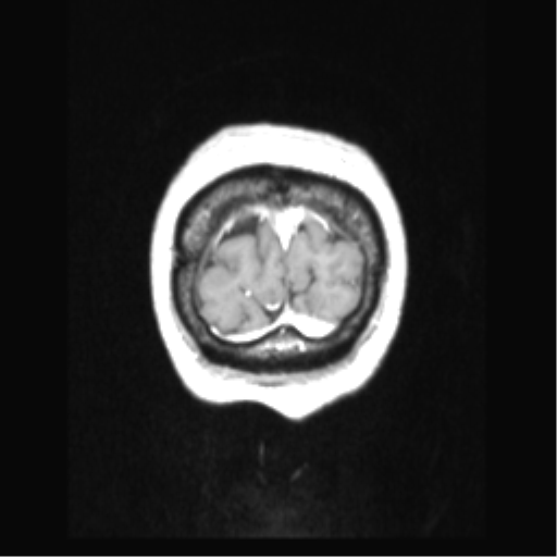 Cerebral arteriovenous malformation with hemorrhage (Radiopaedia 34422-35737 Coronal T1 C+ 8).png