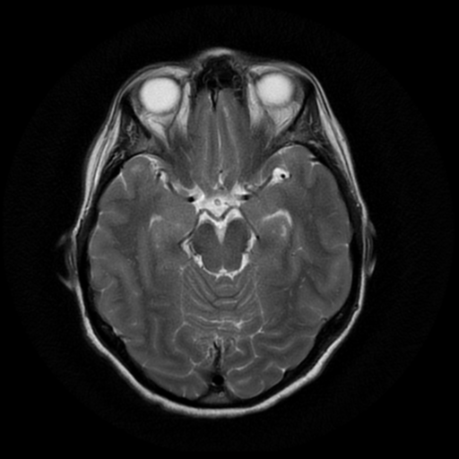 File:Cerebral autosomal dominant arteriopathy with subcortical infarcts and leukoencephalopathy (CADASIL) (Radiopaedia 41018-43763 Ax T2 PROP 8).png