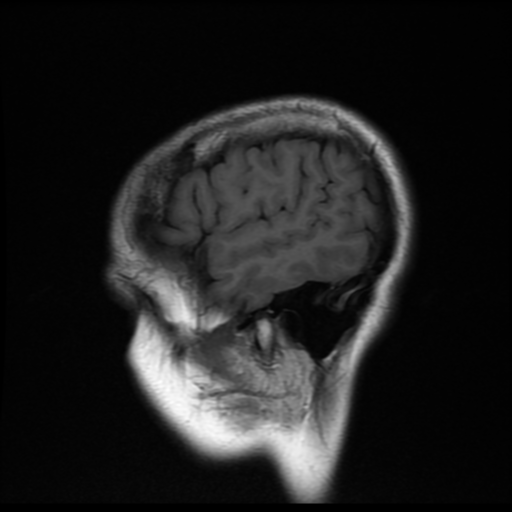 File:Cerebral autosomal dominant arteriopathy with subcortical infarcts and leukoencephalopathy (CADASIL) (Radiopaedia 41018-43768 Sagittal T1 18).png
