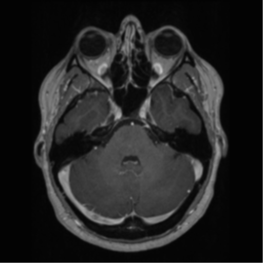 Cerebral cavernoma and development venous anomaly (Radiopaedia 37603-39482 Axial T1 C+ 22).png