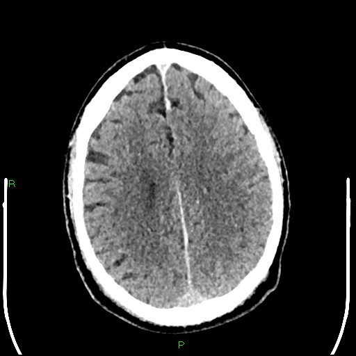 Cerebral contusions (Radiopaedia 33868-35039 Axial non-contrast 149).jpg