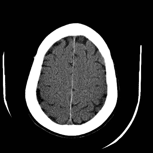 File:Cerebral edema (evolution in time) (Radiopaedia 19418-19440 non-contrast 76).jpg