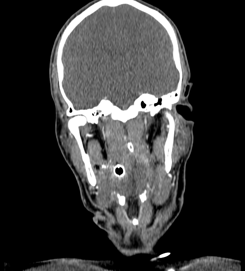 Cerebral edema in an overdose patient (Radiopaedia 72005-82539 B 48).jpg