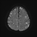 File:Cerebral embolic infarcts (embolic shower) (Radiopaedia 72391-82921 Axial DWI 52).jpg