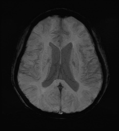 Cerebral embolic infarcts (embolic shower) (Radiopaedia 72391-82921 Axial SWI 42).jpg