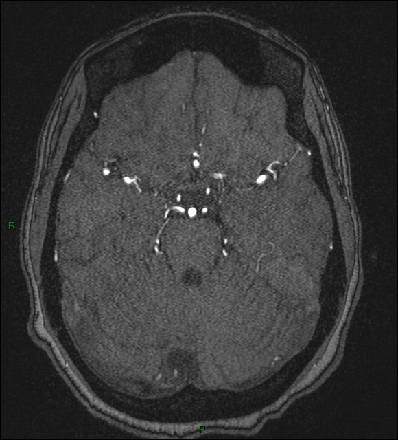 Cerebral fat embolism (Radiopaedia 35022-36525 Axial TOF 72).jpg