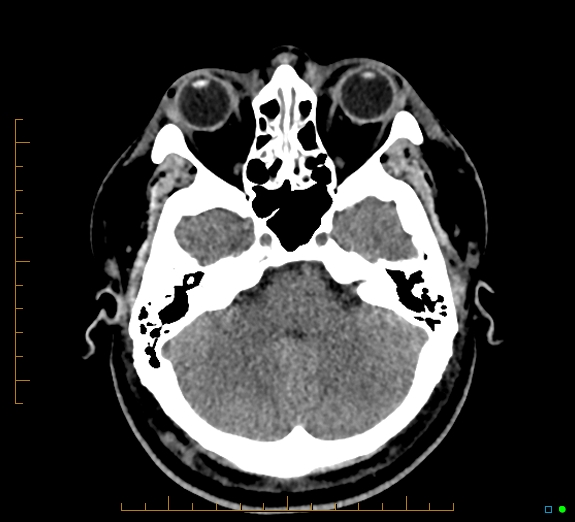Cerebral fat embolism (Radiopaedia 85521-101224 Axial non-contrast 13).jpg