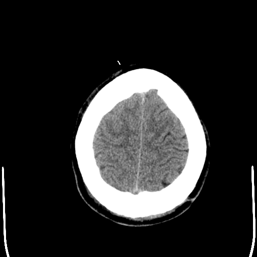 File:Cerebral hemorrhagic contusions- temporal evolution (Radiopaedia 40224-42754 Axial non-contrast 26).png