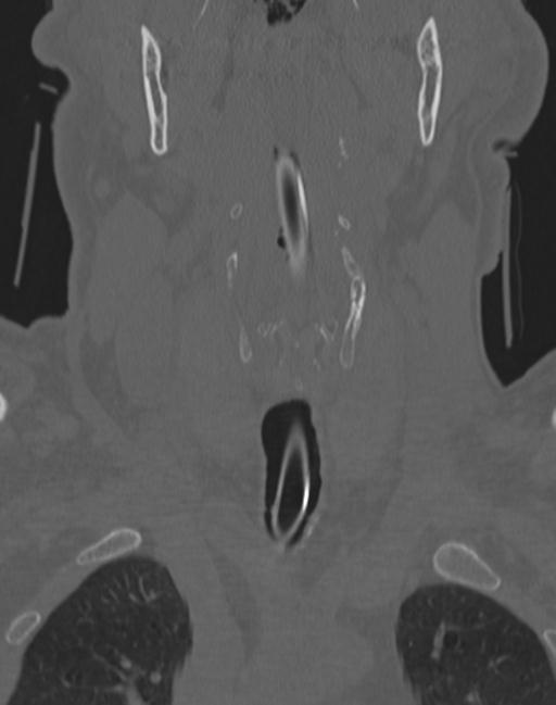 Cerebral hemorrhagic contusions and cervical spine fractures (Radiopaedia 32865-33841 Coronal bone window 11).jpg