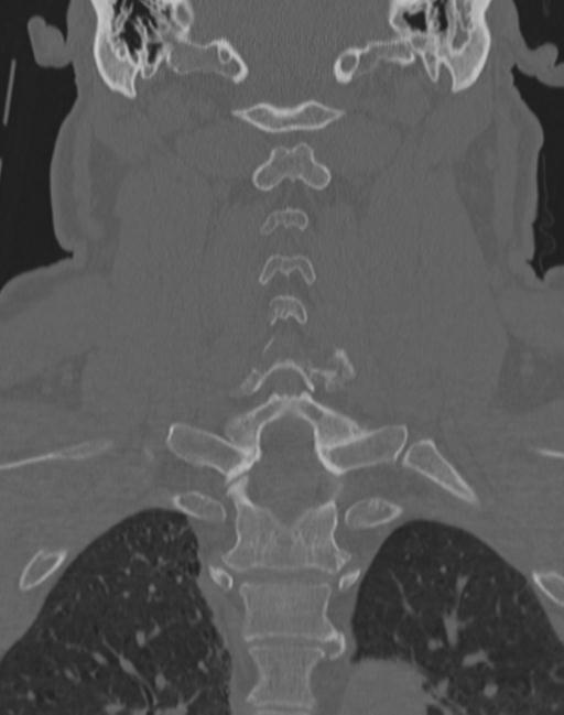Cerebral hemorrhagic contusions and cervical spine fractures (Radiopaedia 32865-33841 Coronal bone window 44).jpg