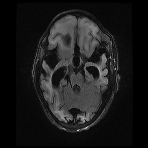 File:Cerebral manifestations of mucopolysaccharidosis type I (Radiopaedia 59171-66487 Axial FLAIR 7).jpg