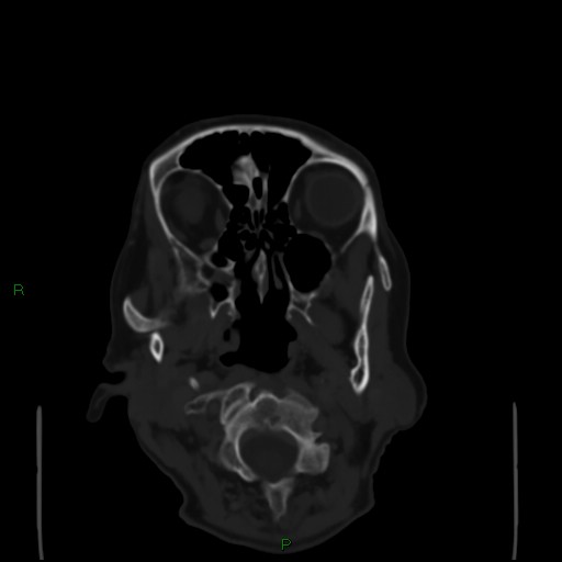 Cerebral metastases - breast primary (Radiopaedia 77653-89857 Axial bone window 7).jpg