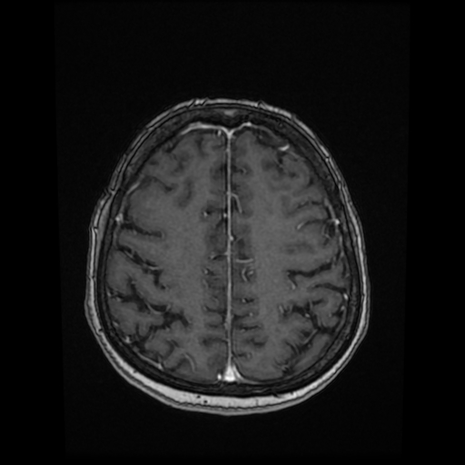 Cerebral metastases - melanoma (Radiopaedia 80972-94522 Axial T1 C+ 71).jpg