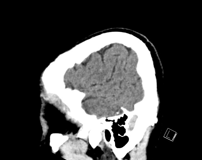 Cerebral metastases - testicular choriocarcinoma (Radiopaedia 84486-99855 F 49).jpg