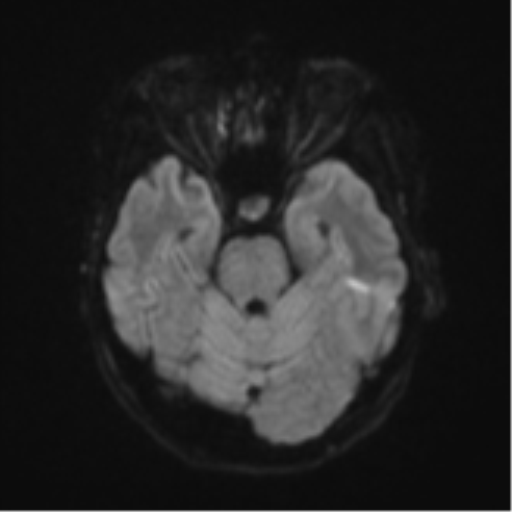 Cerebral metastasis (Radiopaedia 46744-51248 Axial DWI 37).png
