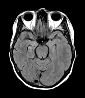 File:Cerebral metastasis (Radiopaedia 46744-51248 Axial FLAIR 10).png