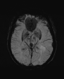File:Cerebral metastasis (Radiopaedia 46744-51248 Axial SWI 15).png