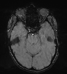 Cerebral metastasis - melanoma (Radiopaedia 54718-60954 Axial SWI 19).png