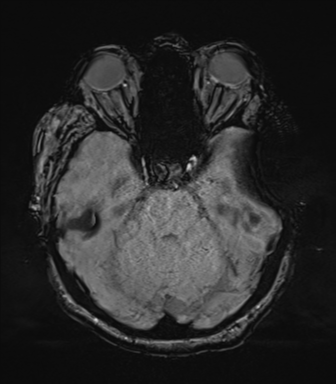 Cerebral metastasis to basal ganglia (Radiopaedia 81568-95413 Axial SWI 25).png