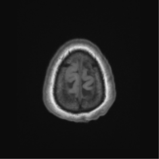 Cerebral metastasis to basal ganglia (Radiopaedia 81568-95413 Axial T1 70).png