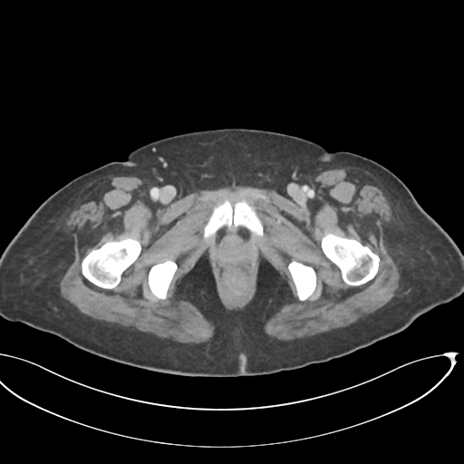 File:Cerebral metastasis to basal ganglia (Radiopaedia 81568-95414 E 79).png