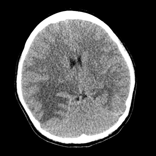 Cerebral tuberculosis with dural sinus invasion (Radiopaedia 60353-68018 Axial non-contrast 29).jpg