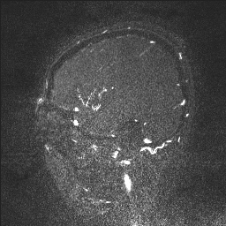 Cerebral tuberculosis with dural sinus invasion (Radiopaedia 60353-68090 Sagittal MRV 28).jpg