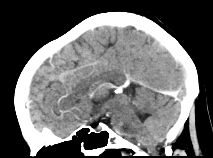 Cerebral venous hemorrhagic infarction (Radiopaedia 57576-64538 Sagittal C+ 28).png