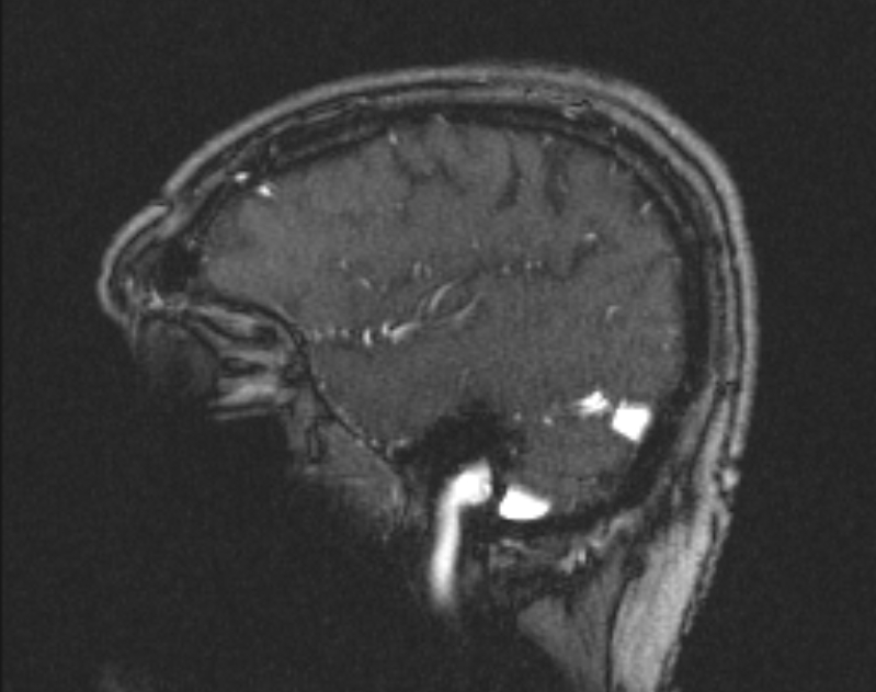 Cerebral venous infarction (Radiopaedia 65166-74176 Sagittal TOF 57).jpg