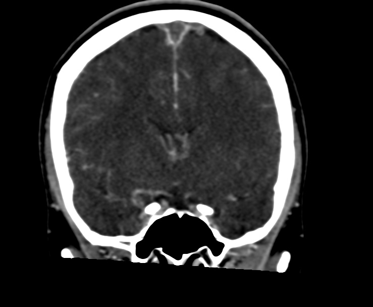 Cerebral venous sinus thrombosis (Radiopaedia 59224-66646 Coronal C+ delayed 30).jpg