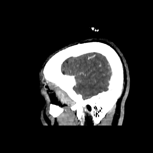 File:Cerebral venous thrombosis (CVT) (Radiopaedia 77524-89685 Sagittal CTV 44).jpg