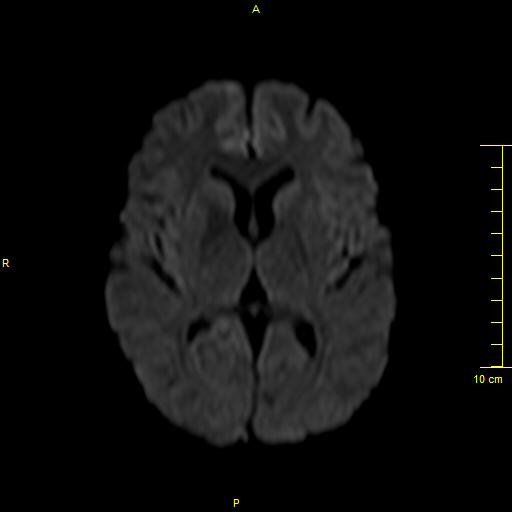 File:Cerebral venous thrombosis (Radiopaedia 23288-23351 Axial DWI 21).JPG