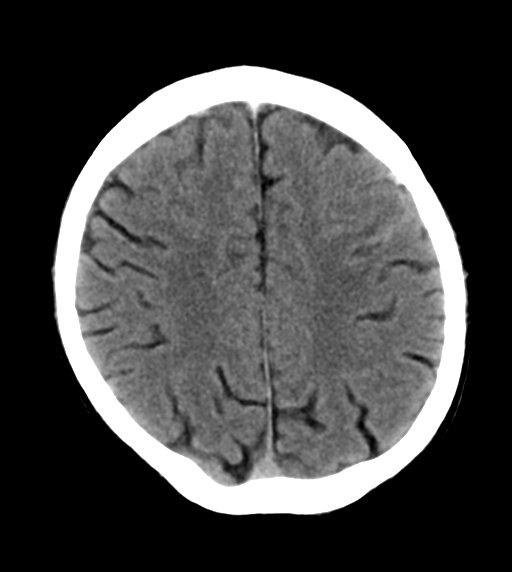 File:Cerebral venous thrombosis (Radiopaedia 38392-40467 Axial non-contrast 20).png