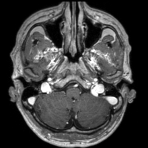 Cerebral venous thrombosis (Radiopaedia 38392-40469 Axial T1 C+ 16).png