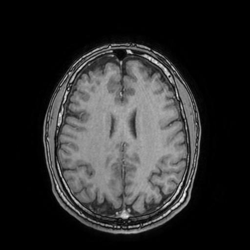 File:Cerebral venous thrombosis with secondary intracranial hypertension (Radiopaedia 89842-106957 Axial T1 C+ 117).jpg