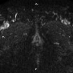 Cervical adenocarcinoma (Radiopaedia 65011-73985 Axial DWI 4).jpg