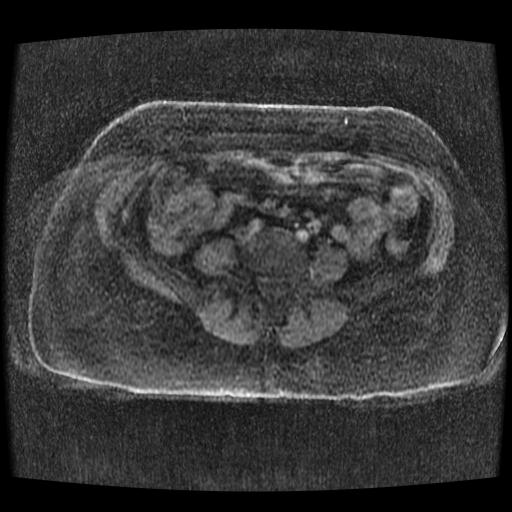 File:Cervical carcinoma (Radiopaedia 70924-81132 Axial T1 C+ fat sat 88).jpg