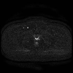 File:Cervical carcinoma (Radiopaedia 85405-101028 Axial DWI 42).jpg
