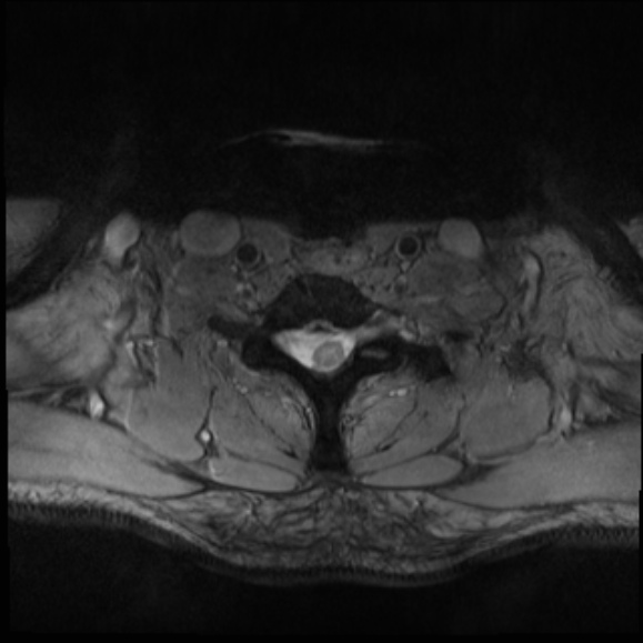 File:Cervical disc extrusion (Radiopaedia 53950-60077 Axial T2 28).jpg