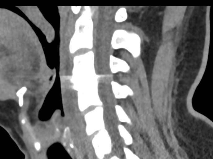 Cervical disc replacement (Radiopaedia 44025-47541 B 54).png
