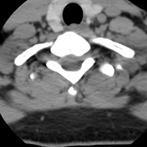 Cervical schwannoma (Radiopaedia 57979-64974 Axial non-contrast 55).png